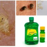 การรักษา Cyclox สำหรับ Bedbugs