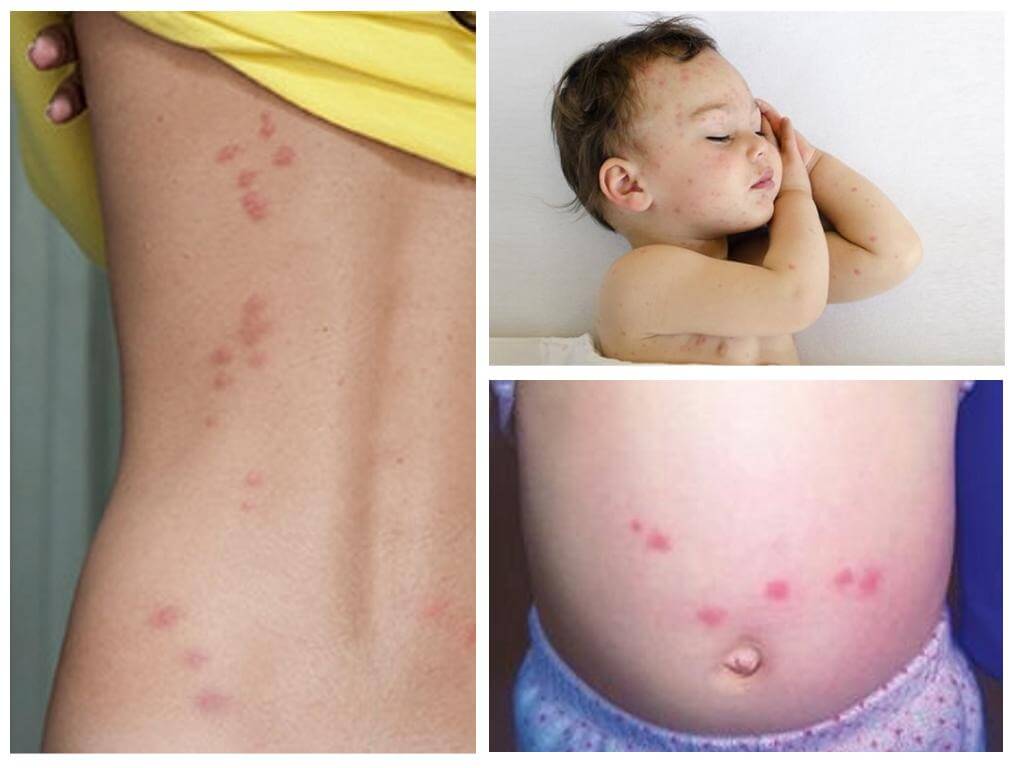 Bedbugs กัดผู้หญิงและเด็ก