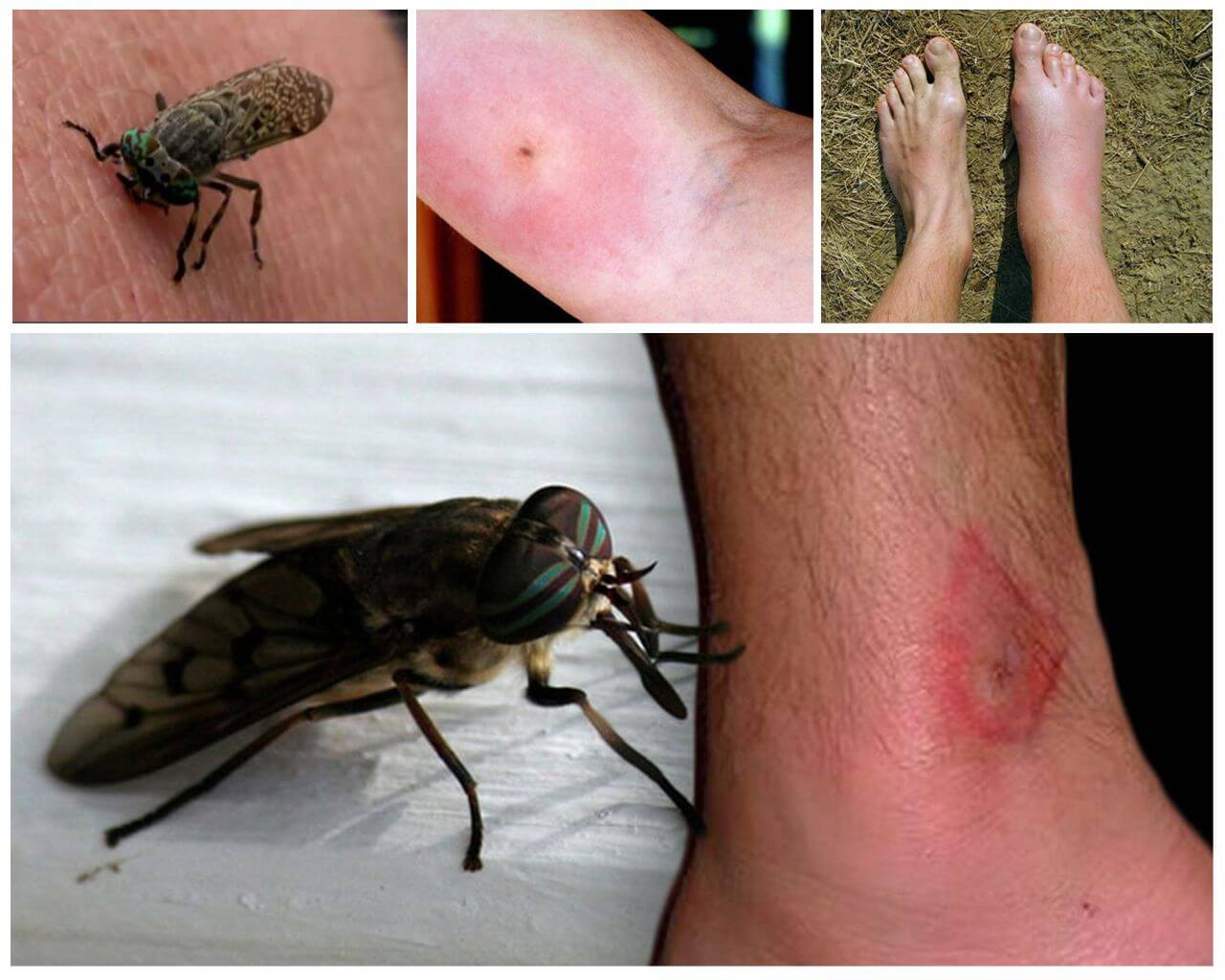 แมลงกัดต่อร่างกายมนุษย์