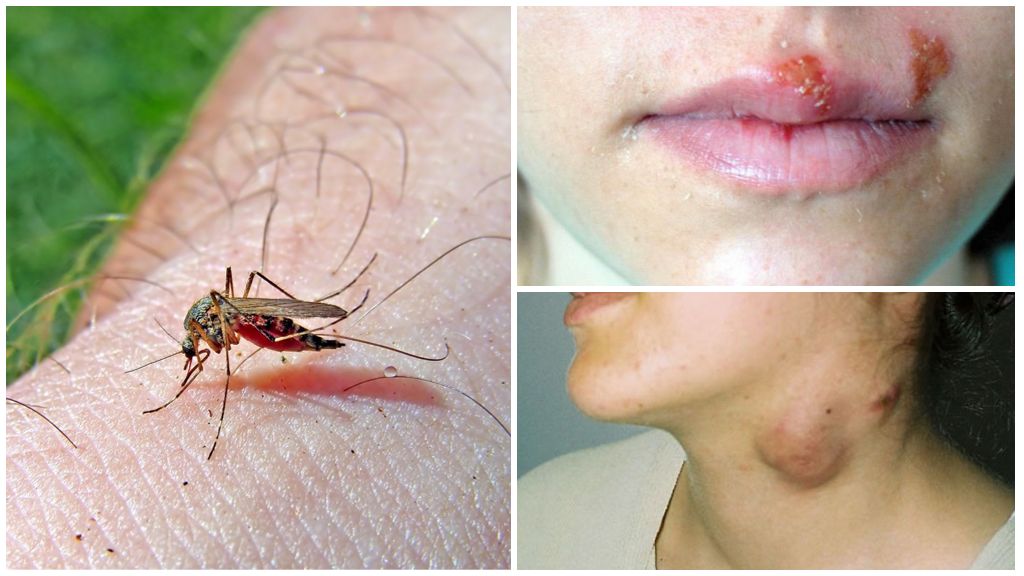 มาลาเรียและไข้เลือดออกสำหรับยุง