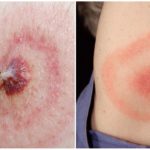 โรค Lyme หรือ Borreliosis Tick-borne