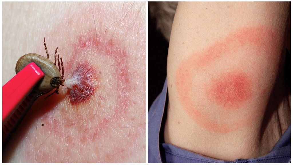 โรค Lyme หรือ Borreliosis Tick-borne